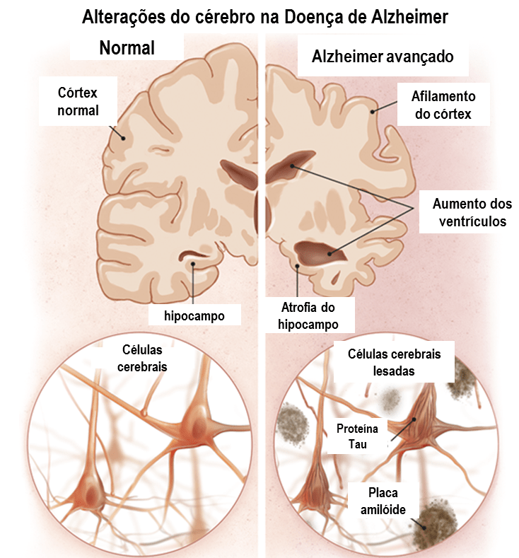 Alterações no cérebro na doença de Alzheimer